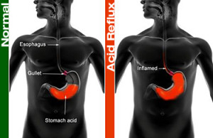 Infant Acid Reflux Natural Treatment Infant Acid Reflux Natural Treatment