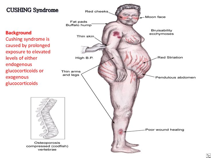 Cushing’s disease treated with holistic medicine by Dr. Tsan