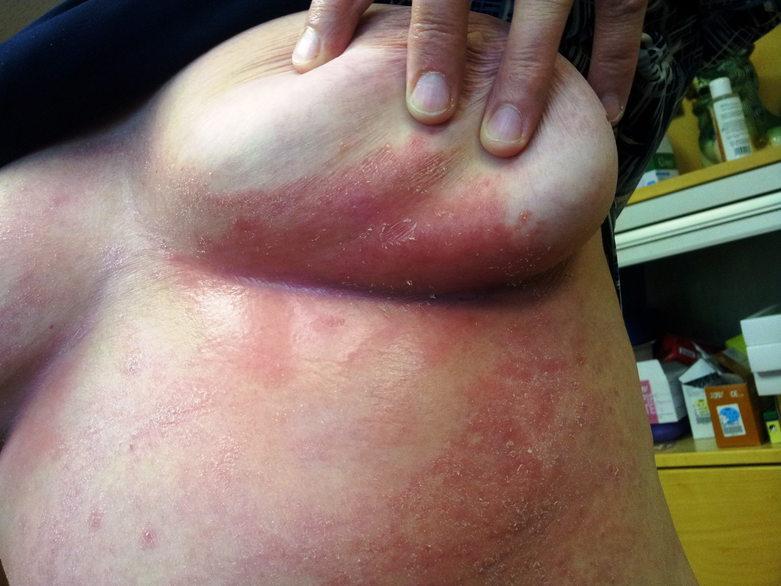 Dermatitis Homeopathic treatment by Dr. Tsan