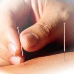 Acupuncture for healthy weight loss