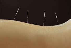 Acupuncture for back pain