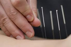 Acupuncture