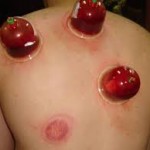 Hijama