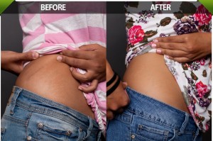 Cavitation Liposuction Result