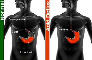 at home remedies for acid reflux