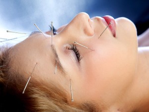 Headaches treated with Acupuncture