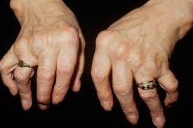 Holistic treatment for arthritis and Homeopathic treatment for arthritis