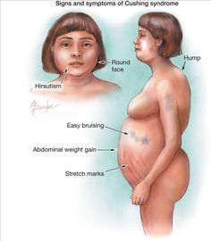 Cushing's disease