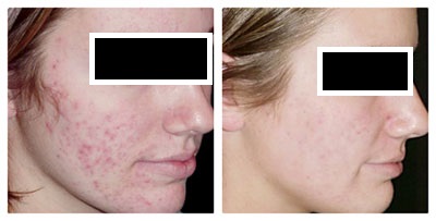 Acne before and after treatment