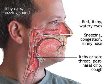 Seasonal Allergies