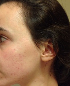 Acne after treatment