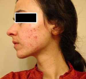 Acne before treatment