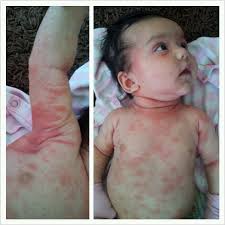 Infant Eczema