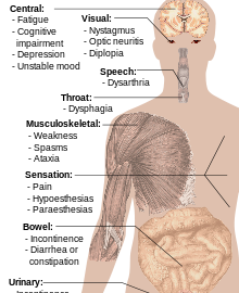 Multiple Sclerosis Symptoms