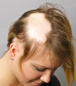 Alopecia Treatment