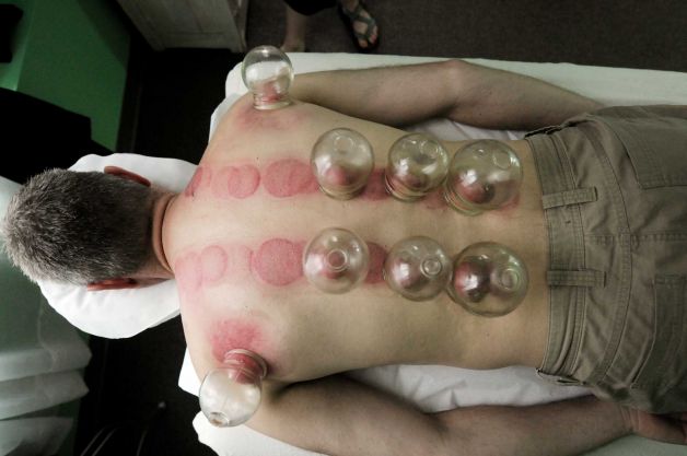 Cupping Therapy Philadelphia