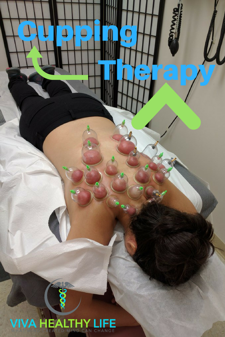 Cupping Therapy, #Hijama and #Acupuncture Philadelphia provided by Dr. Tsan; please contact Viva Healthy Life today to book the appointment for #Cupping Therapy in Philadelphia.