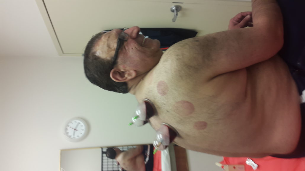 Hijama by Dr. Tsan