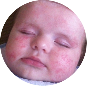 Infant Eczema