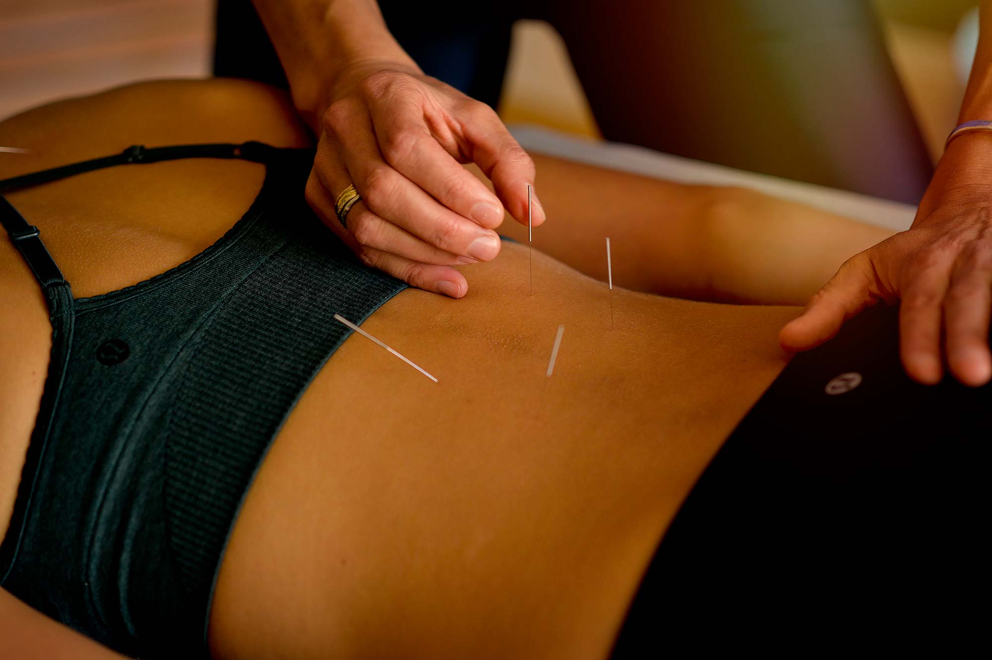 Acupuncture at Viva Healthy Life