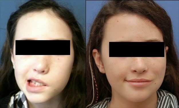 Aсuрunсturе for Bell’s Palsy