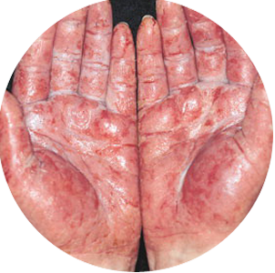 Dermatitis