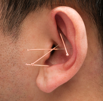 Ear Acupuncture - Auricular Acupuncture