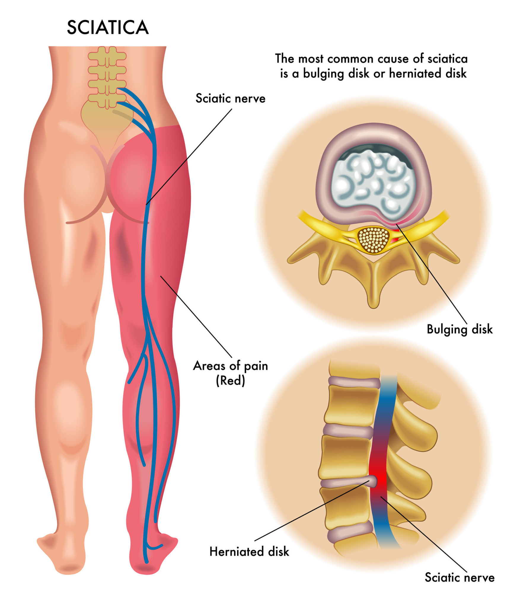 natural treatment for sciatica nerve pain