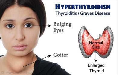 Hyperthyroidism