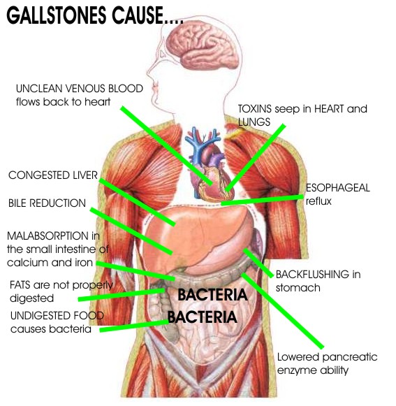 Natural remedies for gallstones