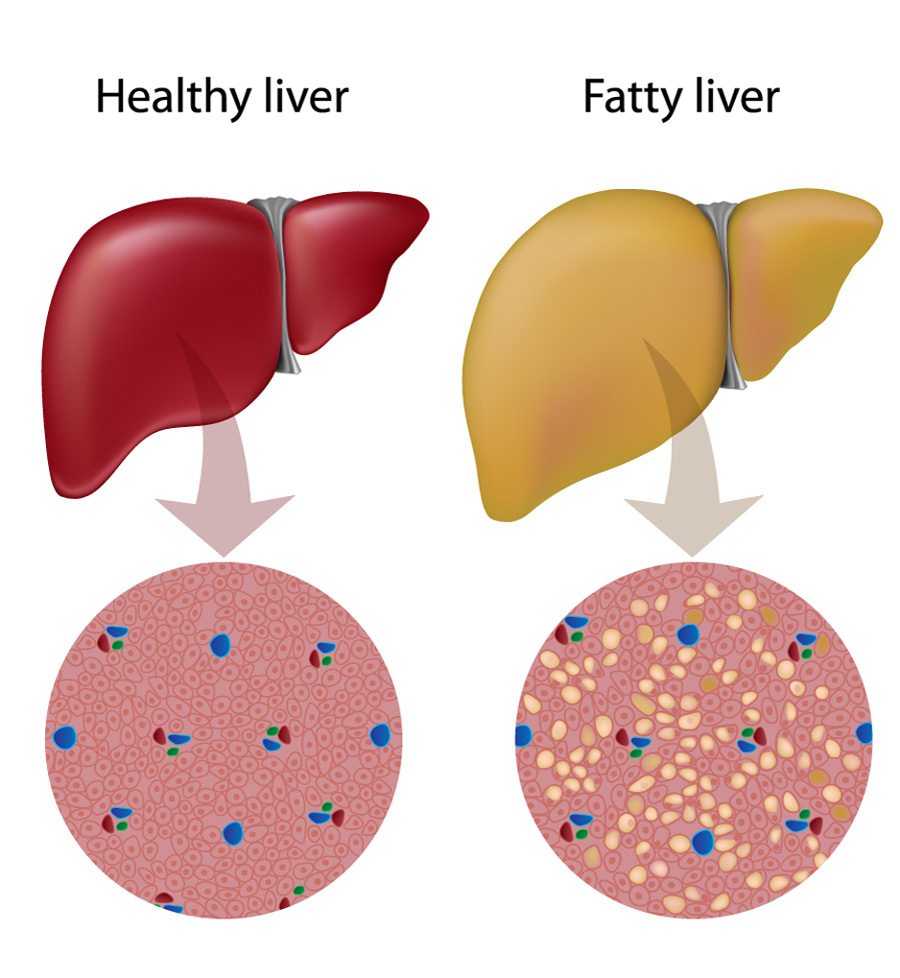 fatty liver, Natural remedies for fatty liver, natural treatment for fatty liver