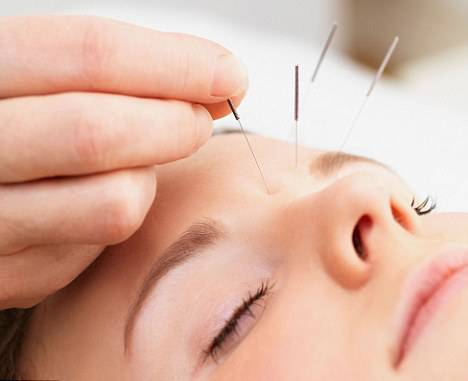 Acupuncture for headache