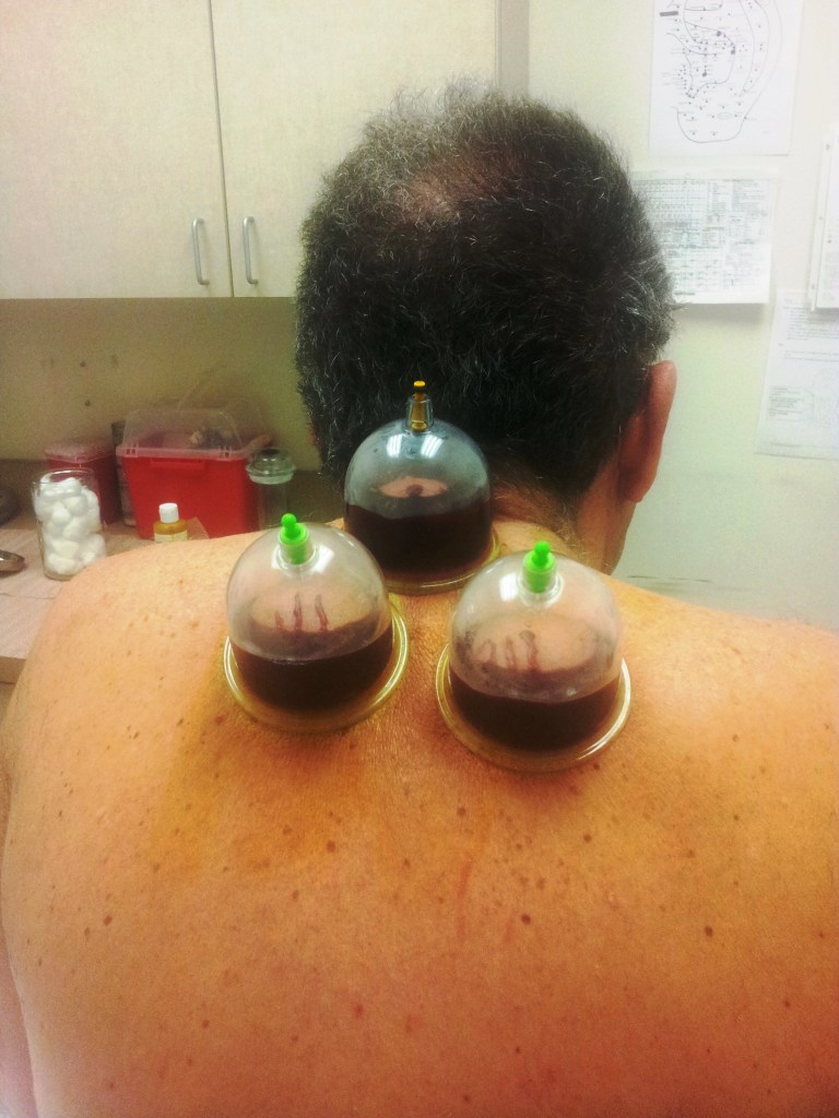 Hijama near me