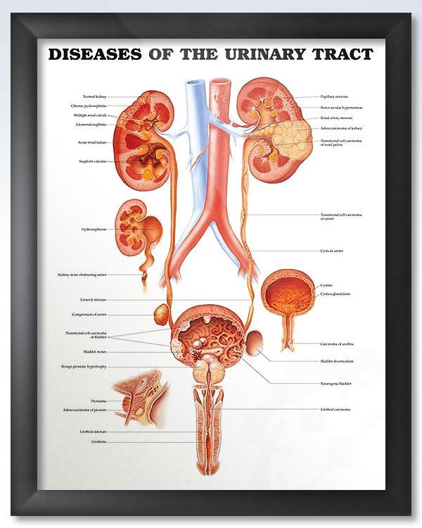 Urinary tract diseases - Natural Remedies for Kidney disease