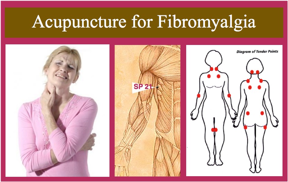 Acupuncture for Fibromyalgia