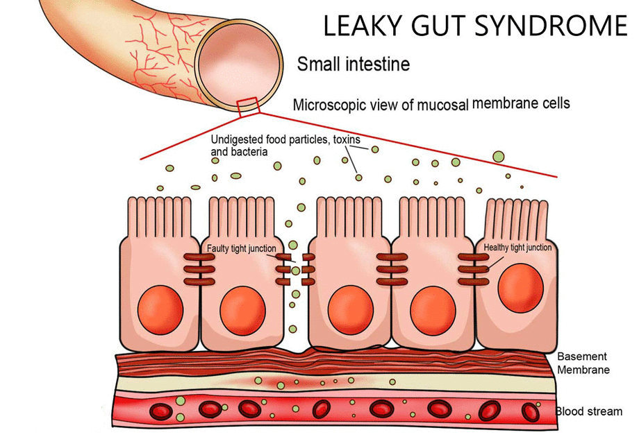 Acupuncture for leaky gut