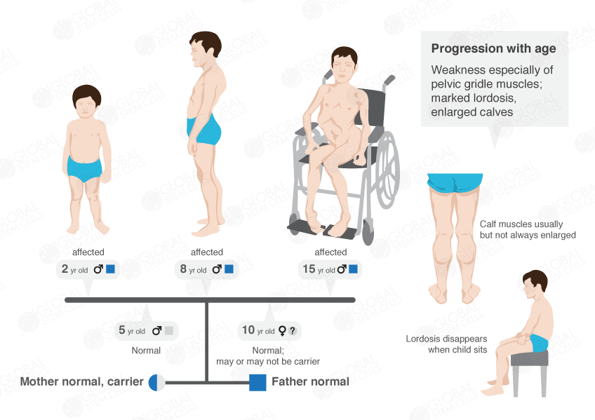 muscular dystrophy