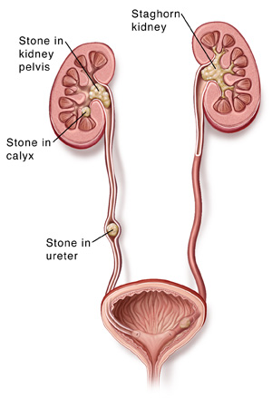 Kidney stones natural treatment