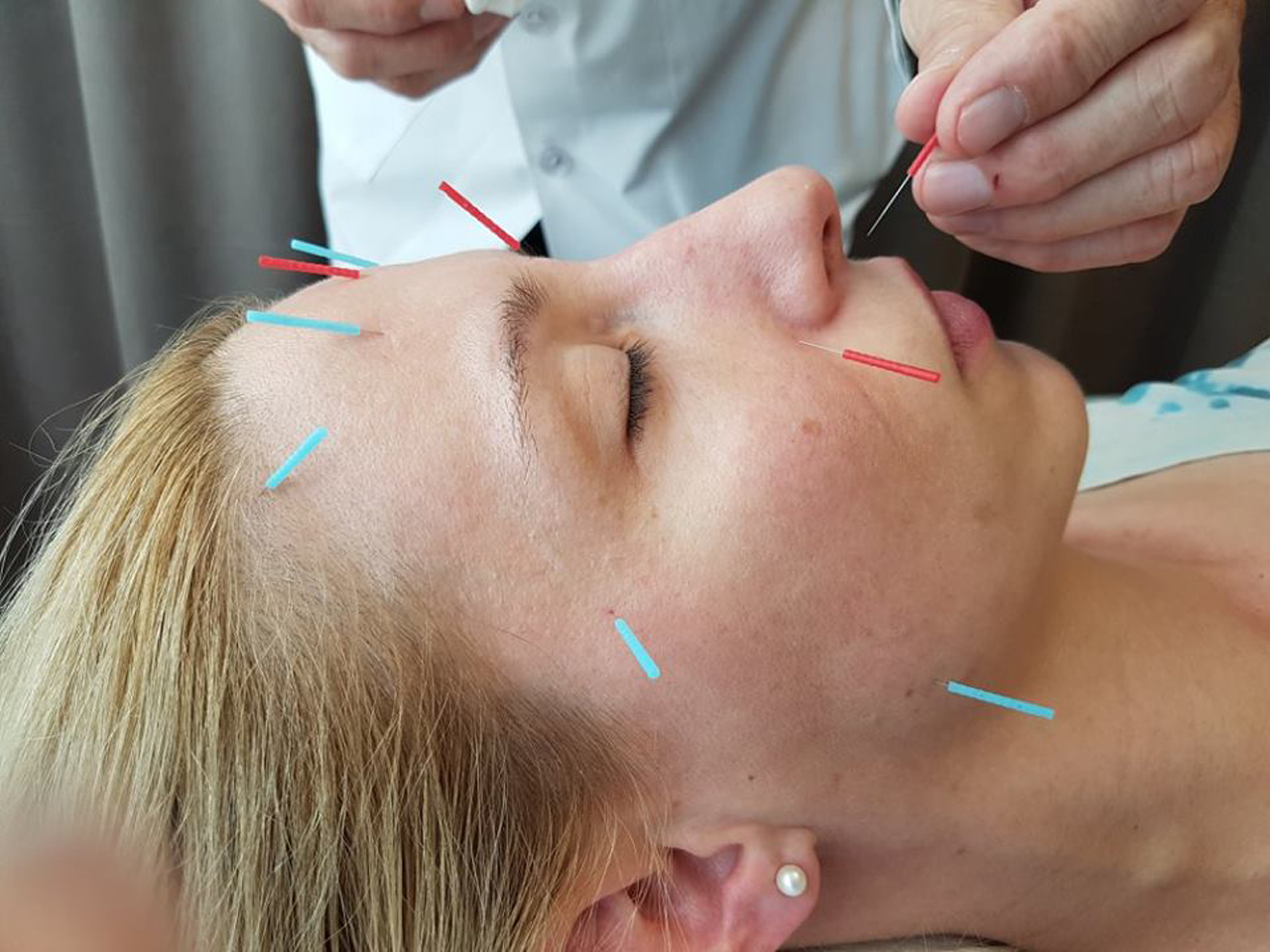 Facial acupuncture