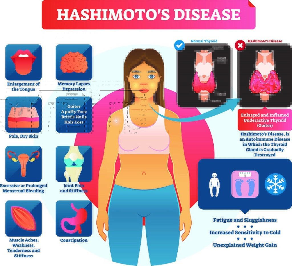 hashimoto's disease