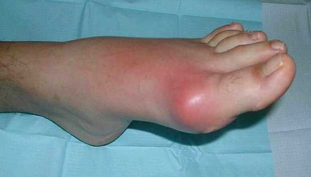 Gout
